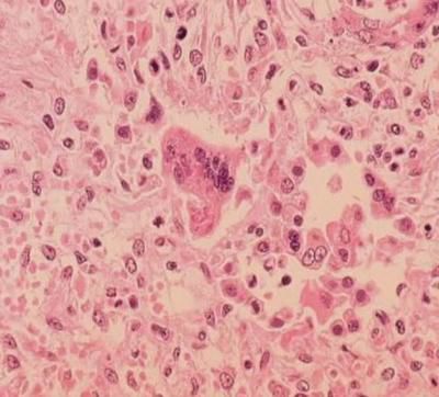 Measles exposure reported at LAX